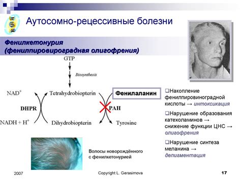 Роль наследственности в формировании горба