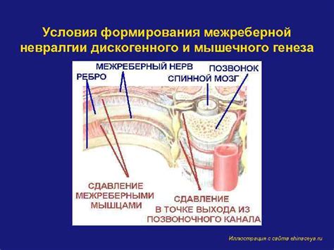 Связь межреберной невралгии с головокружением: научные аргументы