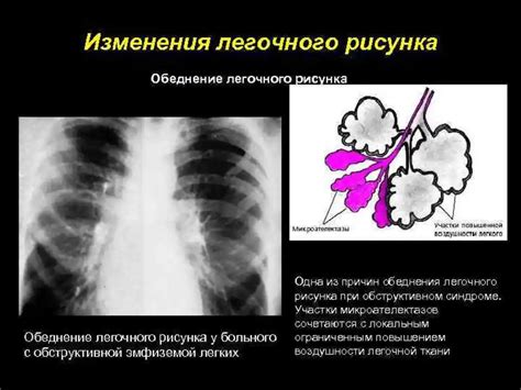 Связь обогащенного легочного рисунка с заболеваниями