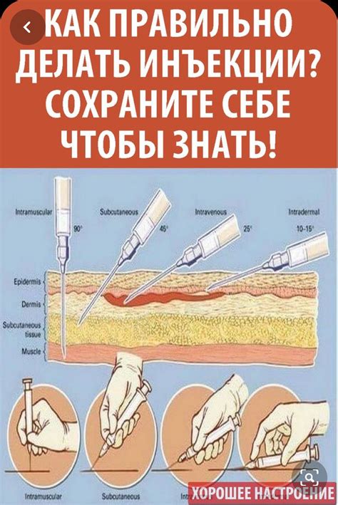 Секреты безопасного введения инъекций в ягодицу