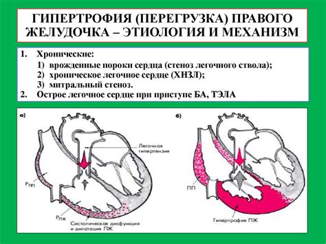 Серьезные последствия выраженных изменений миокарда левого желудочка