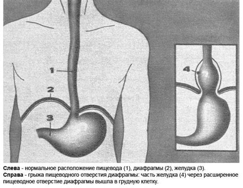 Симптоматика эзофагита пищевода и связанные с ней изменения температуры