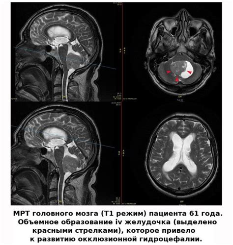 Симптомы викарной гидроцефалии