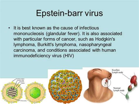 Симптомы вируса Эпштейн-Барр
