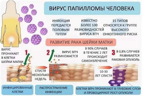 Симптомы вируса папилломы