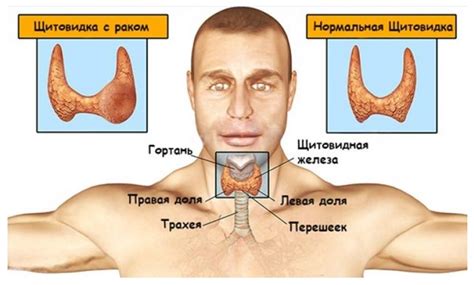 Симптомы и диагностика новообразований щитовидной железы