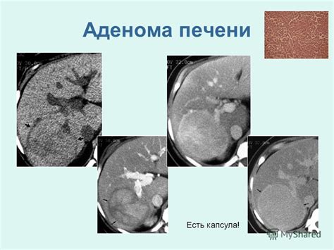 Симптомы новообразований в печени: