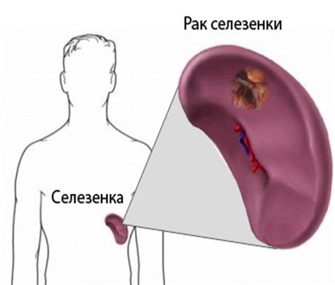 Симптомы патологических процессов селезенки и методы их выявления