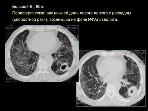 Симптомы ранних признаков метастазов на КТ легких