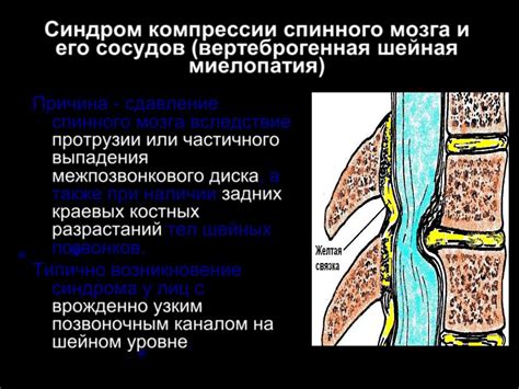 Синдром компрессии нерва: диагноз, приводящий к онемению