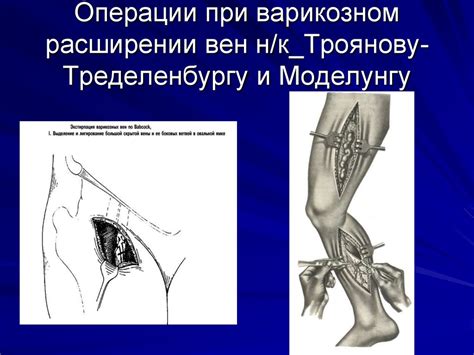 Синдром отечности и нарушение кровообращения при варикозном утолщении кровеносных сосудов