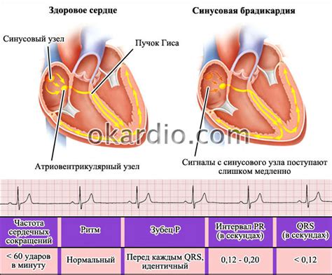 Синусовая брадикардия и психологические требования: взгляд законов и правил