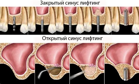 Состояние после процедуры синус лифтинга: физическая активность и тренировки