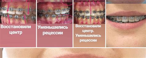 Сочетание ортодонтических брекетов и композитных виниров: рекомендации специалистов