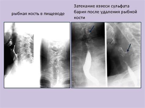 Способы удаления случайно проглоченного осколка рыбной кости