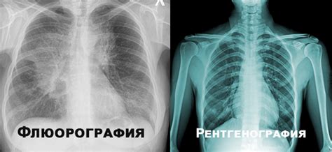 Сравнение использования рентгена и флюорографии в медицине