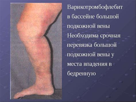 Стимуляция кровообращения и лимфатического дренажа