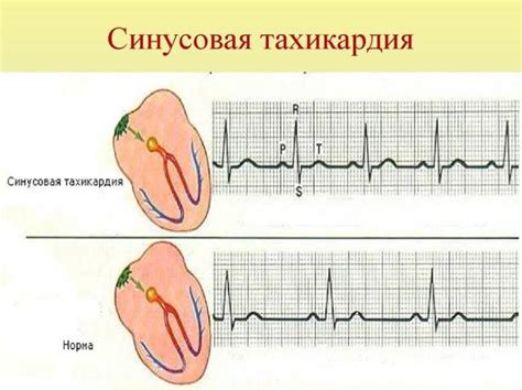 Суть и проявления синусовой тахикардии: понимание основных аспектов