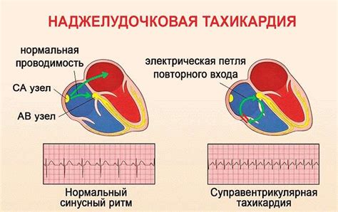 Тахикардия: определение, причины и симптомы