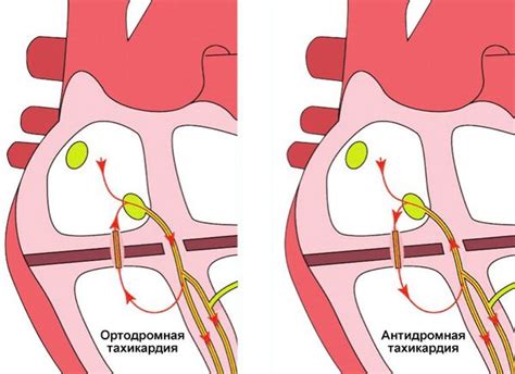 Тахикардия: причины, симптомы и лечение