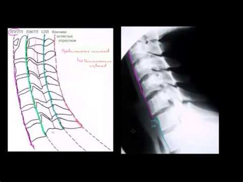 Тема: Особенности видимости различных типов опухолей на рентгеновских снимках позвоночника