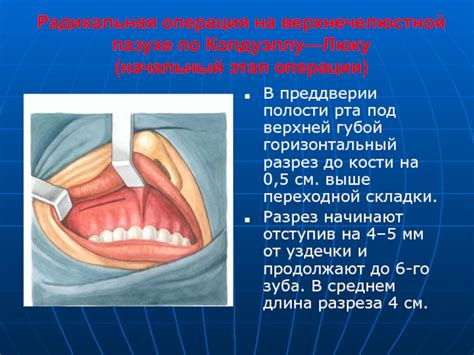 Техники малотравматичного устранения образования в верхнечелюстной полости