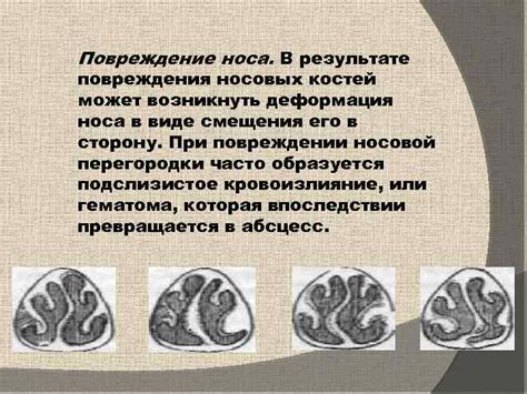 Техники самозащиты при угрозе повреждения носовых костей