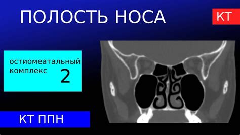 Точное местонахождение антрального отверстия Канина носа Маршака в носовой полости