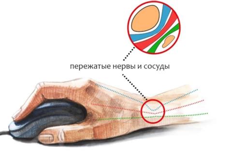 Туннельный синдром запястья: сжатие нервов в запястье