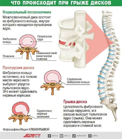 Увеличенный риск формирования грыжи межпозвоночных дисков