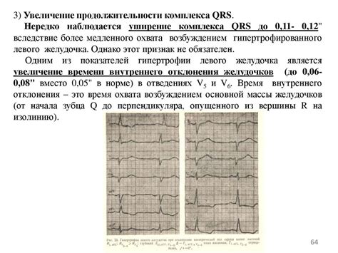 Уширение и оскалывание комплекса QRS: особенности и возможные значения на ЭКГ