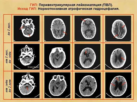 Факторы, ведущие к травме головного мозга у новорожденных