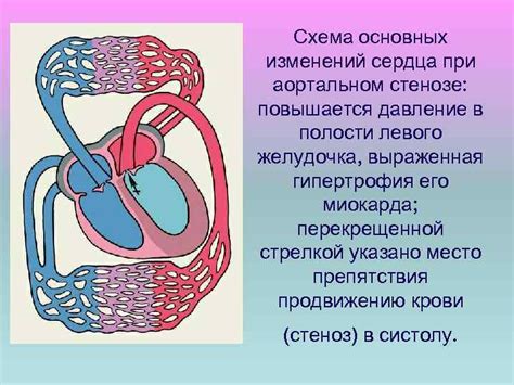 Факторы, способствующие развитию значительных изменений структуры левого желудочка сердца