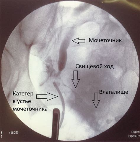 Факторы, способствующие развитию опущения уретры у женщин