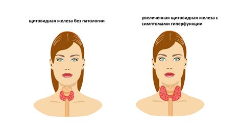 Факторы и значения, указывающие на низкий уровень Тиреотропного гормона (ТТГ)