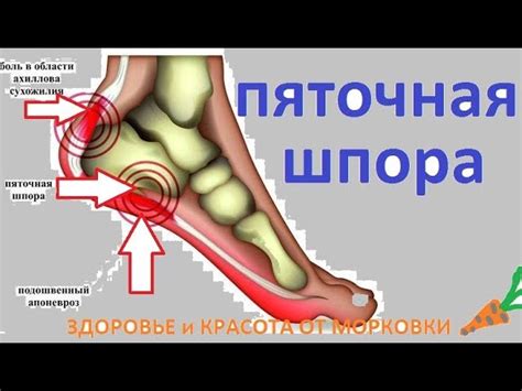 Факторы и предрасполагающие условия появления шпоры на стопе