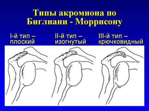 Форма и структура ведущего акромиона по классификации Bigliani