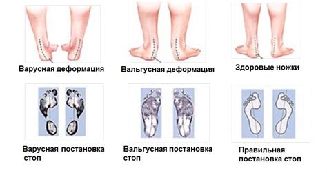 Функциональные изменения при отклонении внутрь стопы у малыша