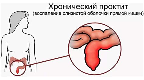 Хронический проктит и абсцессы