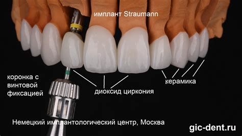 Циркониевая коронка – инновационное решение для восстановления естественной красоты зубов