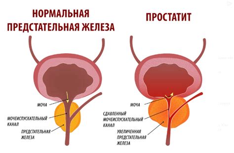 Что такое новообразование в простате