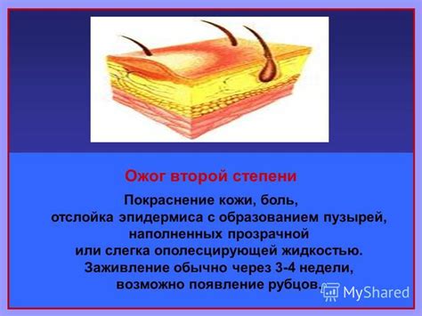 Что такое повреждение кожи 2 степени с образованием пузырей