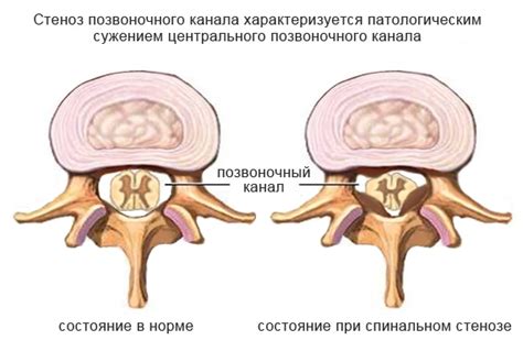 Что такое сужение позвонков в поясничном отделе и как оно проявляется