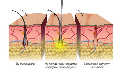 Электроэпиляция: эффективность и долговременность