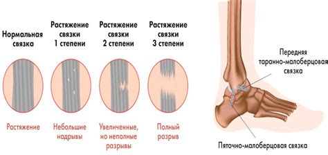 Эффективное применение холода для облегчения растяжения связок