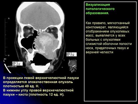  Альтернативные подходы к лечению кисты в верхнечелюстной пазухе 