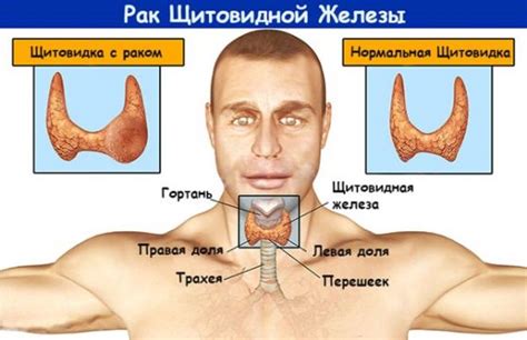  Взаимосвязь между повышенным уровнем щитовидной железы и появлением угрей 