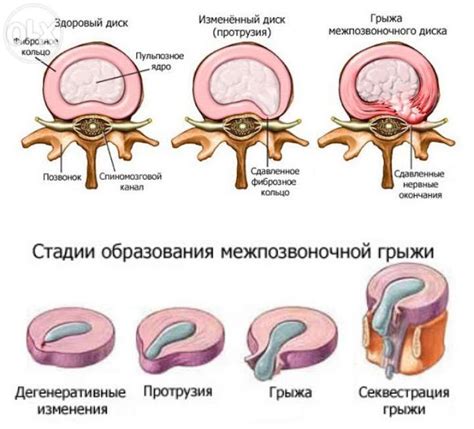  Виды грыж позвоночника и их особенности 