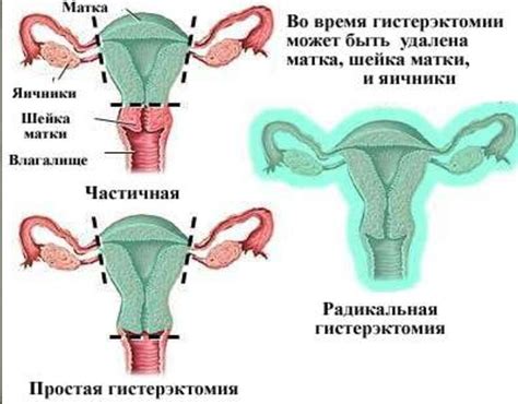  Влияние удаления матки на гормональный баланс, физическое и эмоциональное состояние 