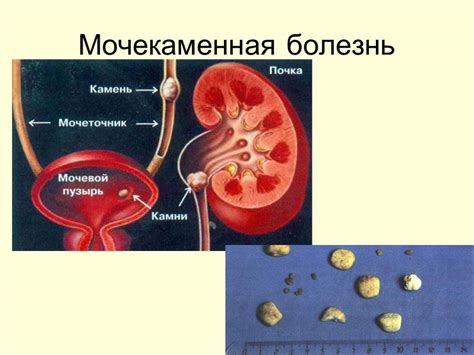  Профилактика возникновения взвесей в мочевом пузыре у детей: советы и рекомендации 